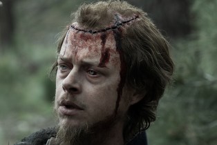 Close up of Jacob Pratt (Dane DeHaan) and his gnarly head wound sewn up